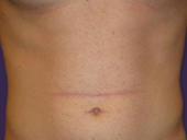 Patient # 78698 Before Photo # 1